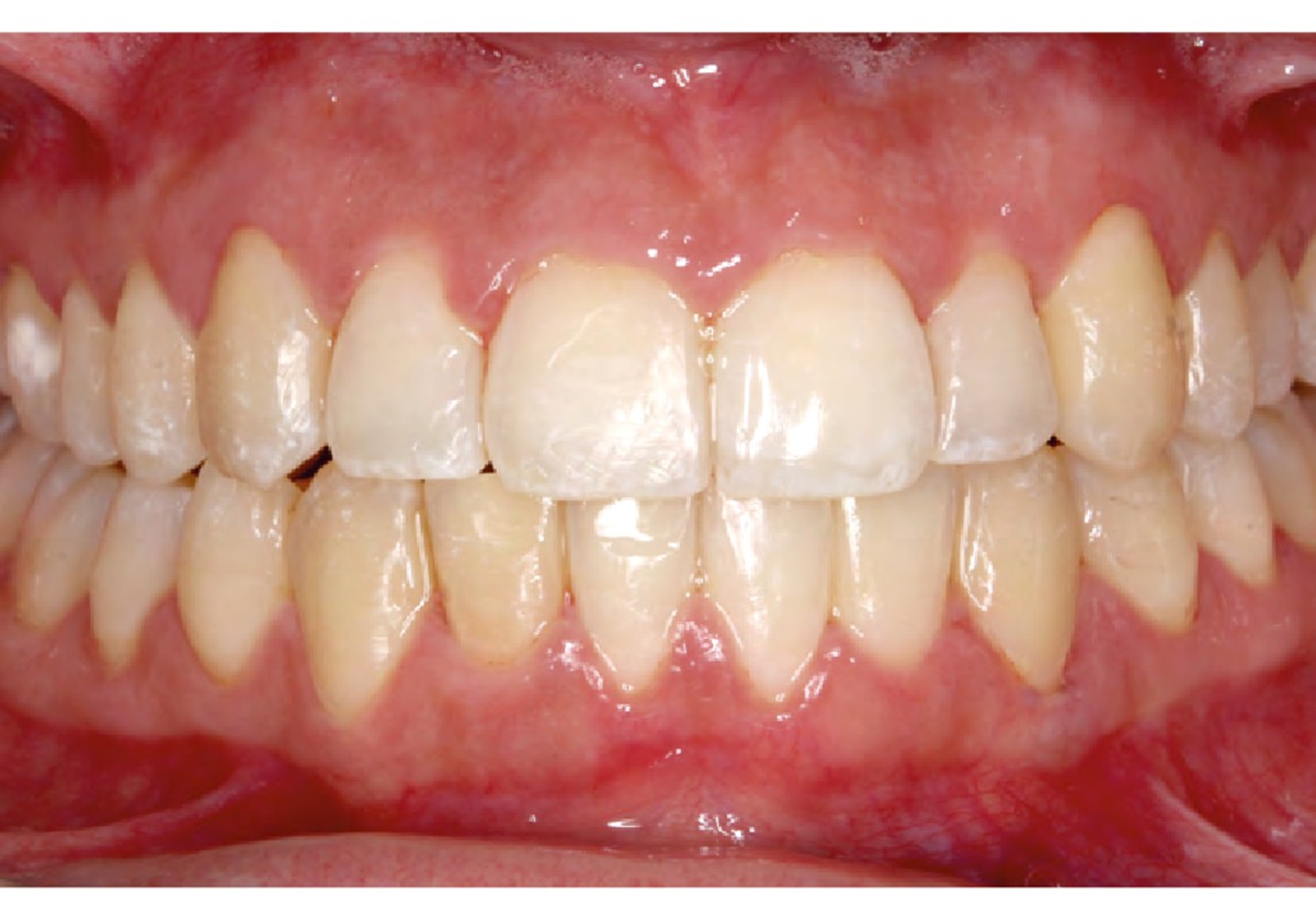 La misma sonrisa al terminar el tratamiento, con todos los dientes alineados en la arcada